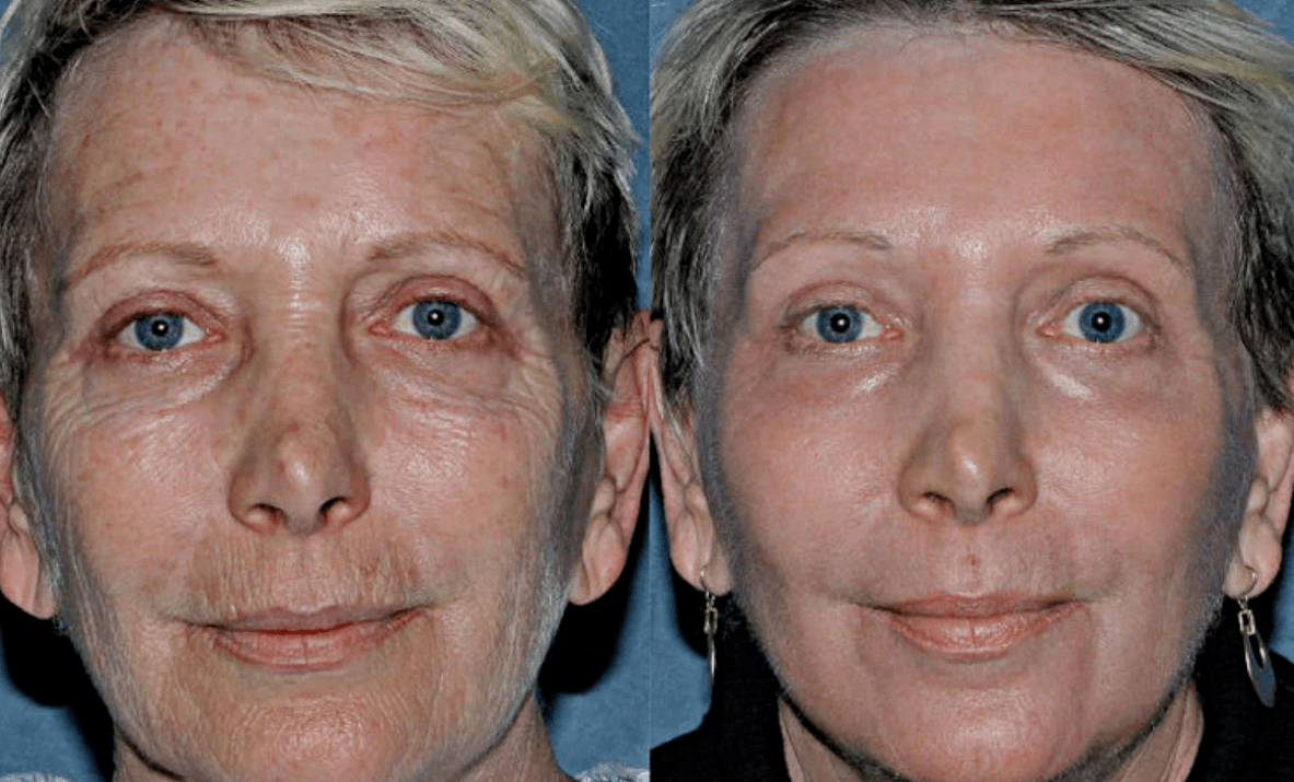before and after